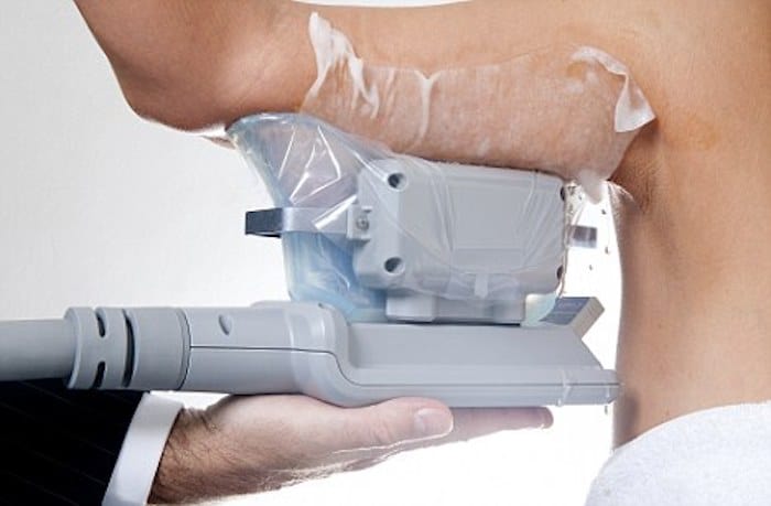 fat freezing arms Colchester