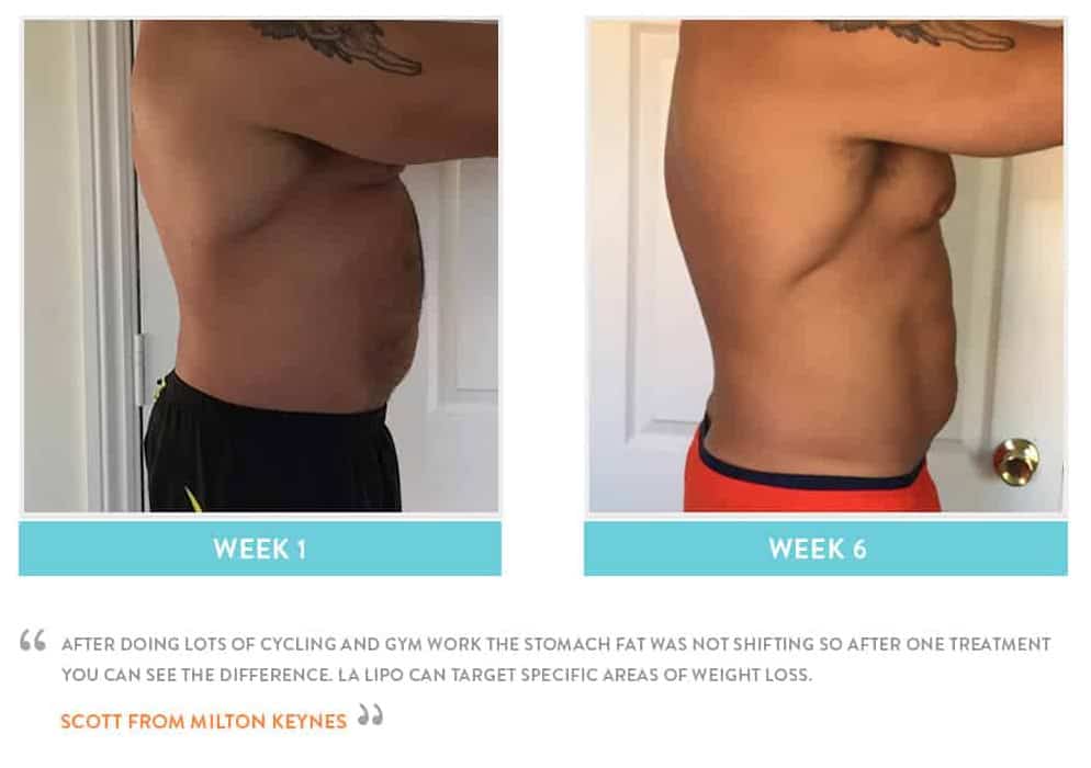 Before & After Stomach Fat Colchester