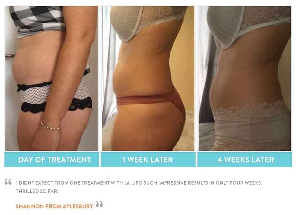 before, Cryolipolysis Colchester