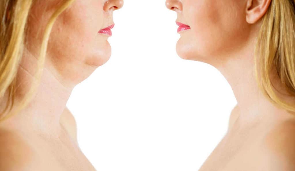 Double Chin treatment Colchester before and after results