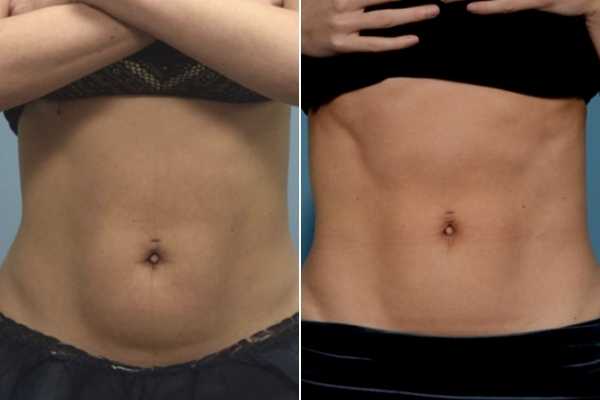 body sculpting FAQs Colchester