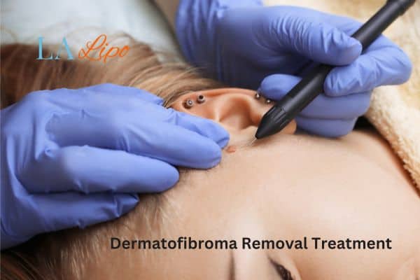 Dermatofibroma Removal Treatment Colchester