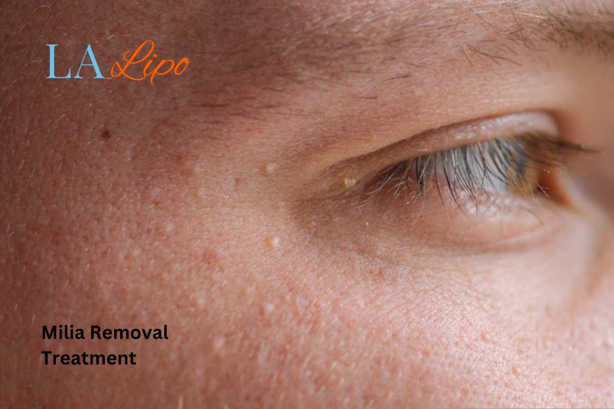 Cryopen Milia Removal: Is It the Easiest and Safest Option Colchester?
