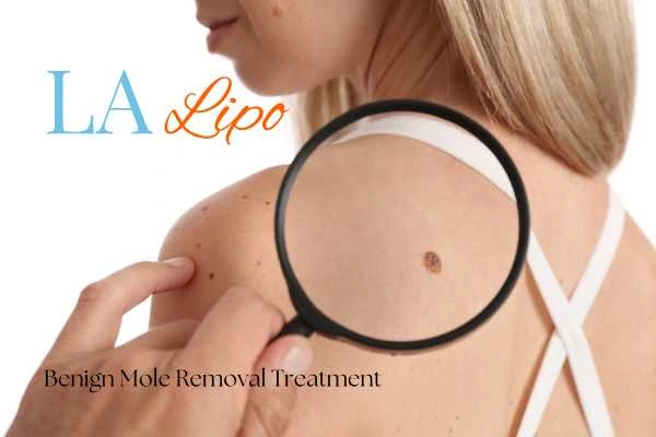 Woman having her inspection of blemish before mole removal Colchester