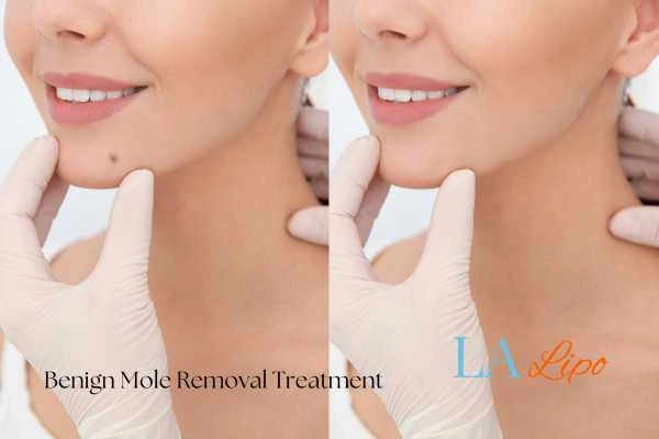 Before and after mole removal Colchester treatment