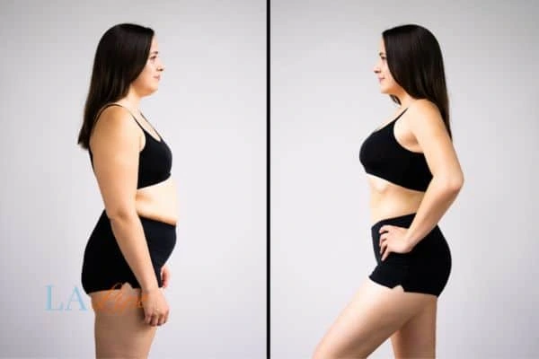 LA-EMS Body Sculpting Colchester results before and after of womans results on body toning.