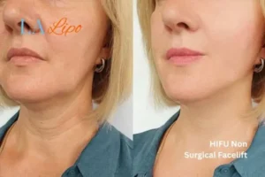 hi-fu for wrinkles Colchester before and after results