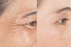 Before and after results of woman - HI-fu wrinkles reduction treatment Colchester
