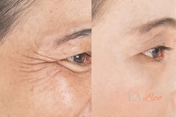 Before and after results of woman - HI-fu wrinkles reduction treatment Colchester