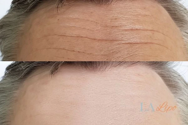 results of HIFU Colchester on mans forehead to help reduce lines and wrinkles