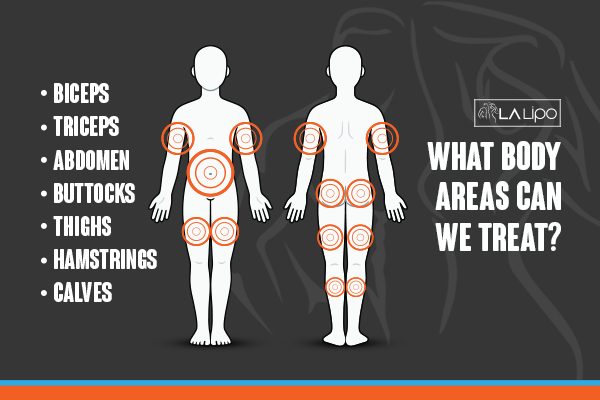 Graphic to show areas you can have LA-EMS Body Sculpting Colchester treatment.