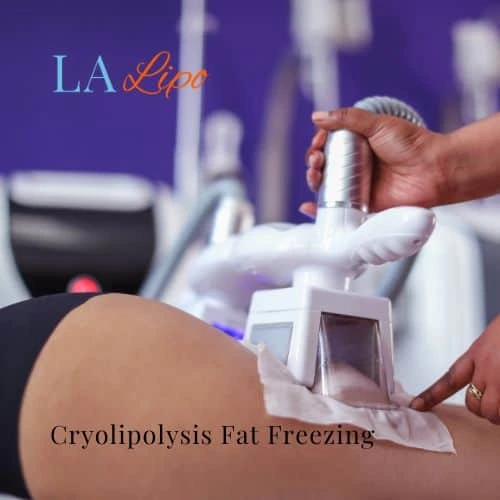 fat freezing - Cryolipolysis Colchester