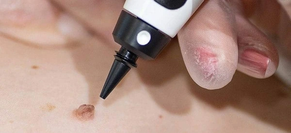 skin tag removal using cryopen Colchester