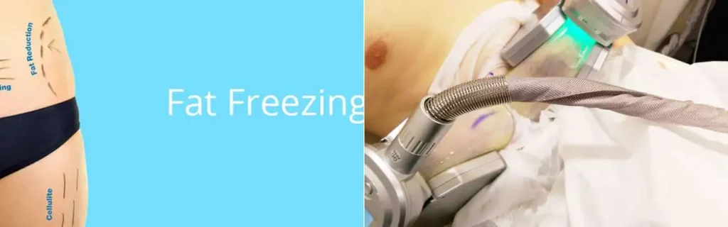 multi areas of a persons body having coolsculpting Colchester treatment