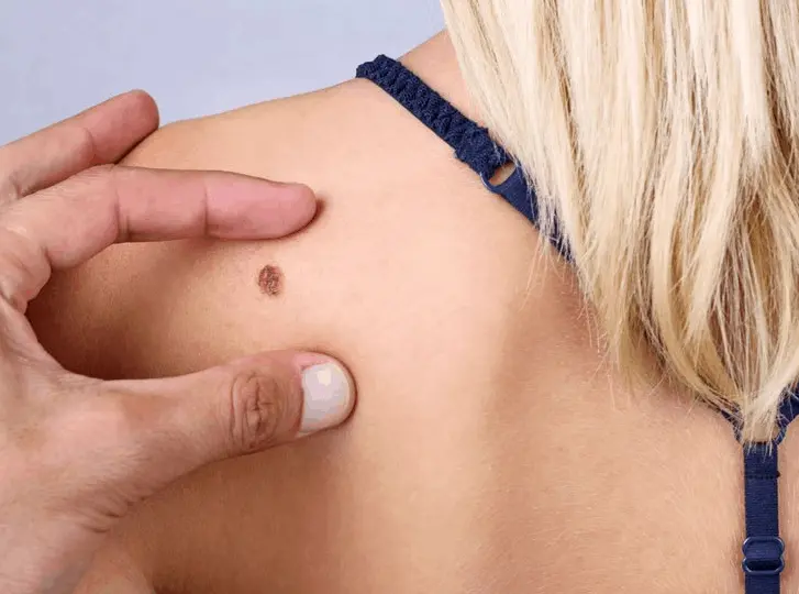 woman having mole removal Colchester consultation before treatment.