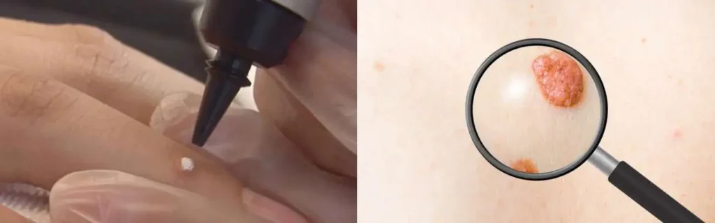 Cryopen for mole removal Colchester - speak to our team today!