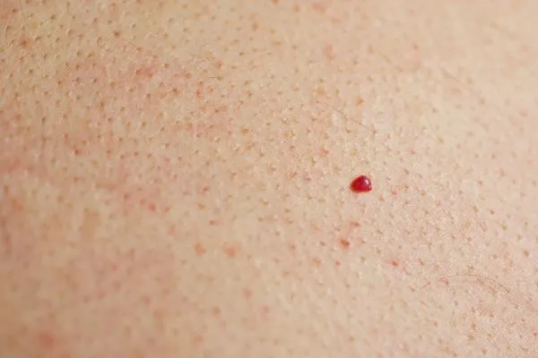 close up of a cherry angioma Colchester