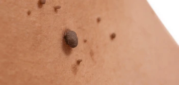 image of a skin tag Colchester