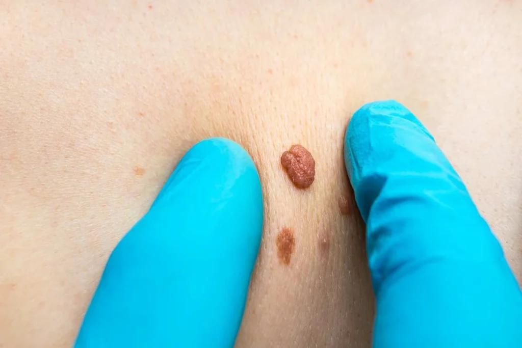 Consultant examining a skin tag Colchester