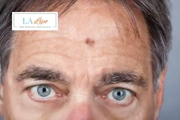 Solar Lentigo Removal Colchester image of man with mark on his forehead