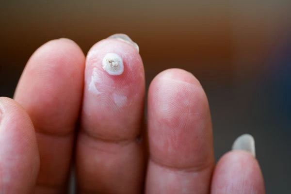 wart on person finger - cryotherapy to treat from LA LIPO Colchester