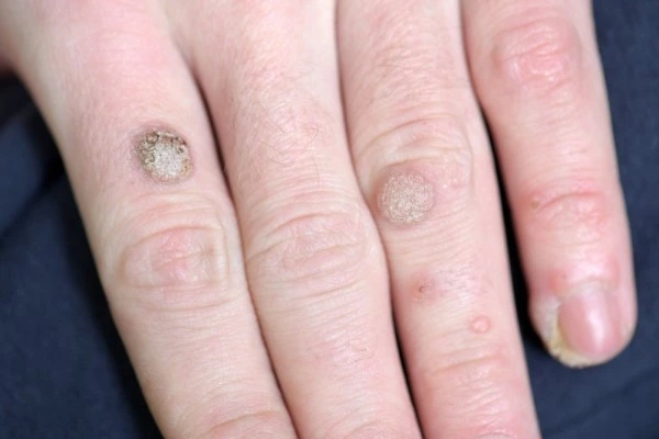 photo of warts on person hand - see wart removal Colchester from LA LIPO