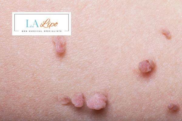 Does cryopen skin tag removal Colchester hurt? Find out now call our team today!