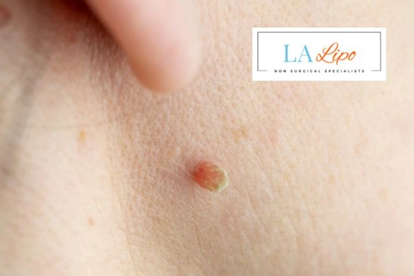 Book skin tag removal Colchester today speak to our team now!