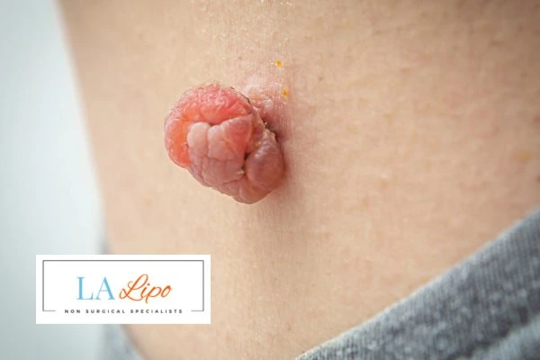 Interested in skin tag removal Colchester? Concerned about the pain? Find out more today!