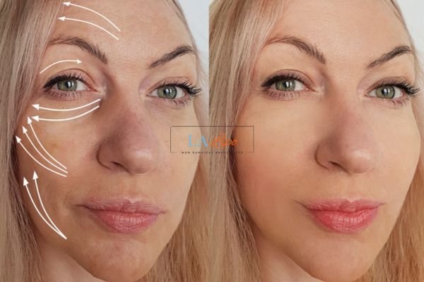Morpheus 8 results Colchester face lift.