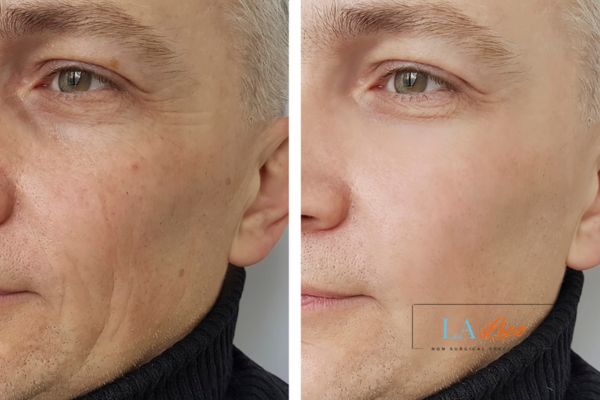 See the amazing results of Morpheus8 Treatment Colchester!