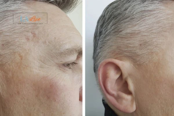 Mens Before & After Morpheus 8 Results Colchester