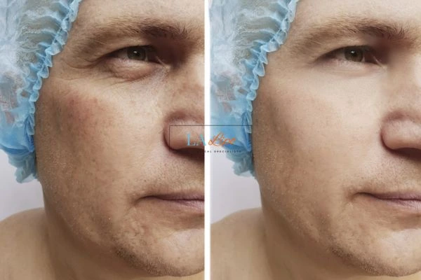 Before and after Morpheus 8 Results Colchester