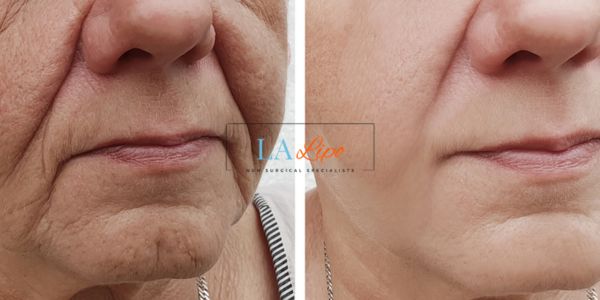 Older lady deeper wrinkle reduction - LA LIPO Morpheus 8 Results Colchester