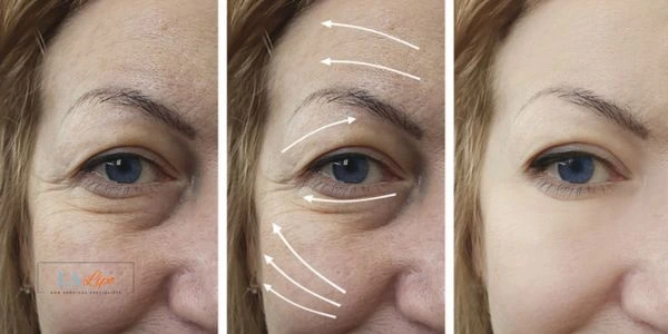 Amazing eye lift Morpheus 8 results Colchester