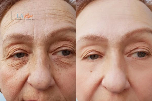 The powerful benefits of Morpheus8 Treatment Colchester - Call Our team today!