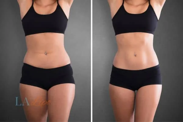 before and after results of non-surgical treatment to help a woman's body image and mental health Colchester