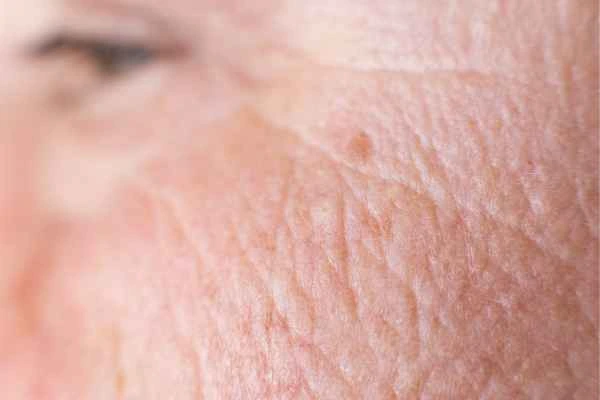 close up picture of a woman's face showing an age spot Colchester