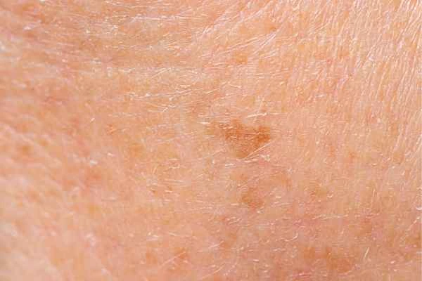 close up picture of age spots Colchester