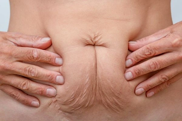 Image of a woman's stomach with loose skin - example of skin tightening Colchester options