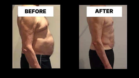 What Symptoms Can Diastasis Recti Cause in Men? Weak Core, Back Pain and Poor Posture Colchester